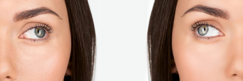 Épilation laser sécurisée réalisée par le Dr Patricia Lemeunier à Metz